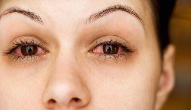 नेत्र संक्रमण (आई फ्लू) से बचाव के लिये रखें जरूरी सावधानियाँ