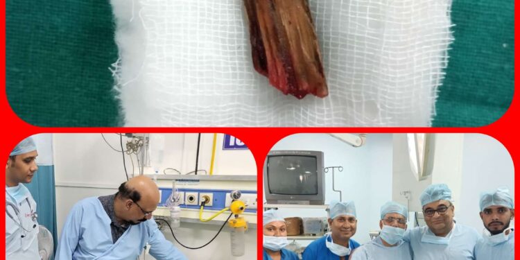 गरीब मरीज के लिए जीवनदान के साथ वरदान साबित हुआ,15 दिन से फंसी लकड़ी को निकालने डॉ ने की जटिल सर्जरी…